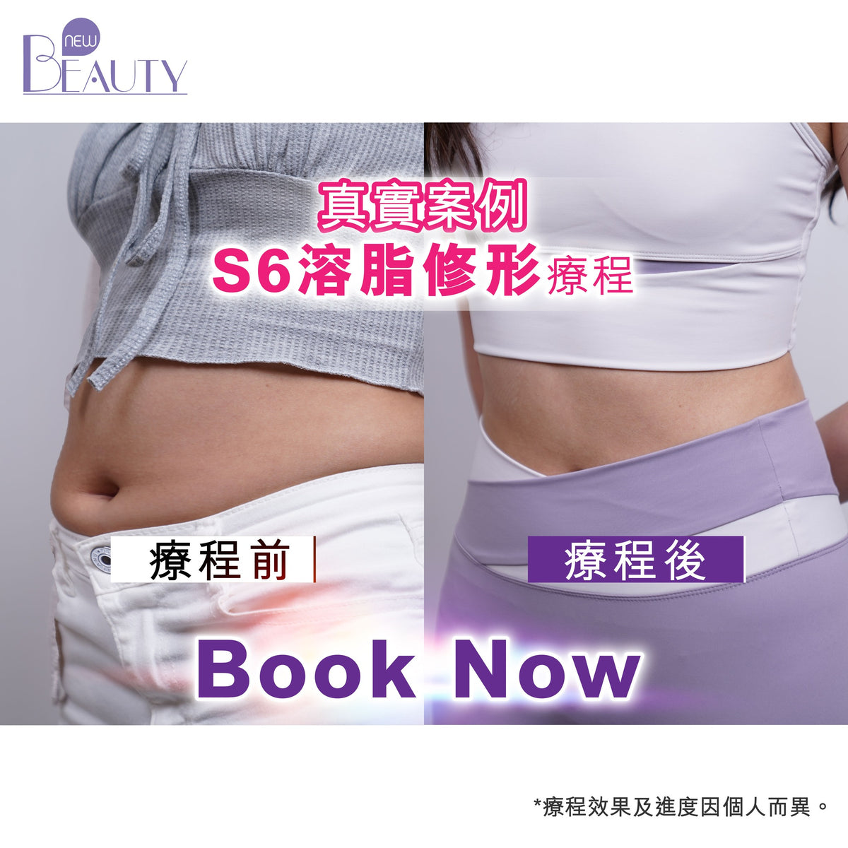 【新客網店優惠】S6溶脂修形療程✨$988/5次 | 送full body 脂肪檢測