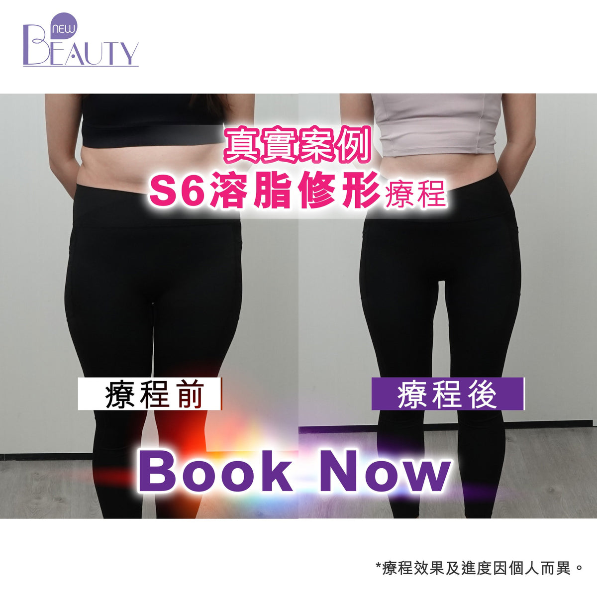 【新客網店優惠】S6溶脂修形療程✨$988/5次 | 送full body 脂肪檢測
