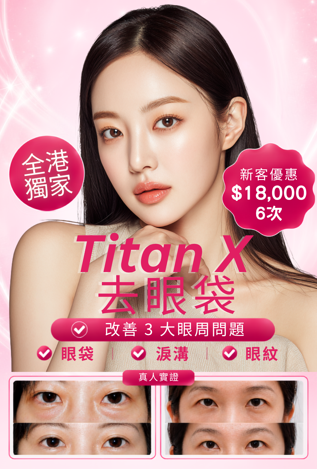 Titan X 去眼袋