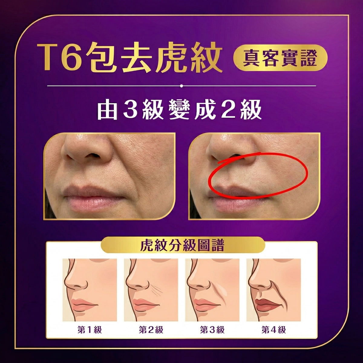 【新客網店限定】虎紋救星🔥T6去虎紋療程 $988/5次