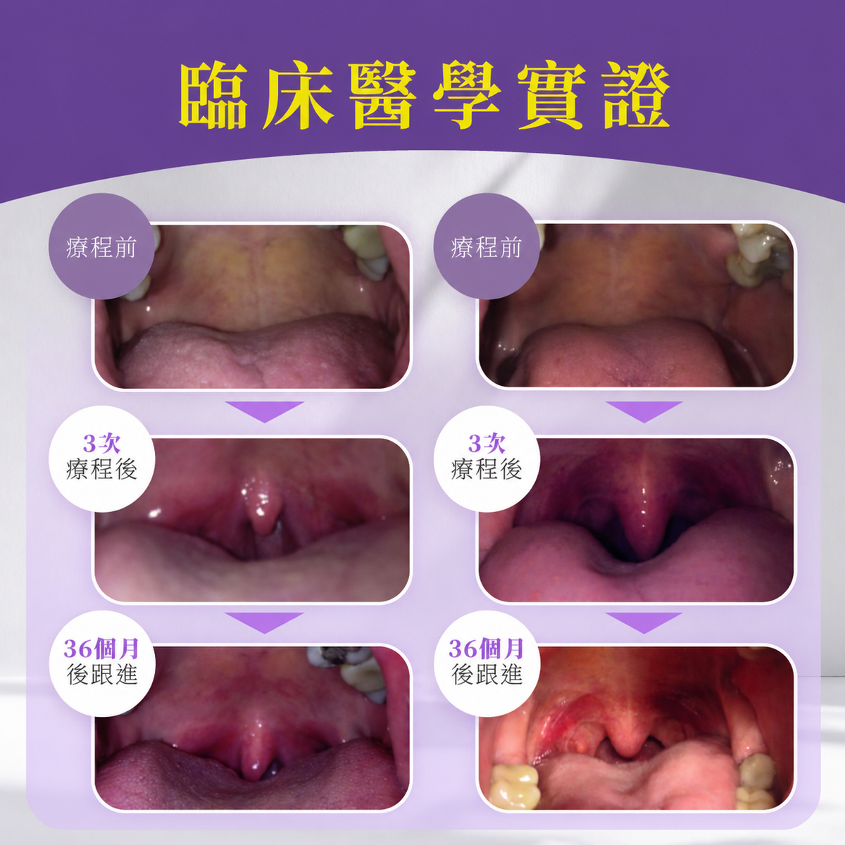 【新客網店優惠】N8包去鼻鼾療程✨$988/5次 | 送 專業超聲波檢測